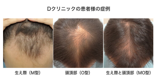 初めてのaga治療 Agaとは 原因 治療効果 副作用 Aga 薄毛治療の相談は発毛医療のdクリニック東京へ 21年255万人のaga治療実績